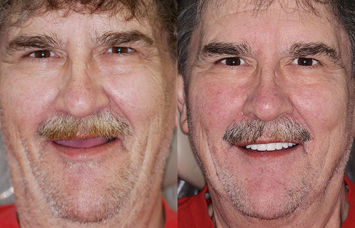 Custom-Fit Functional Dentures