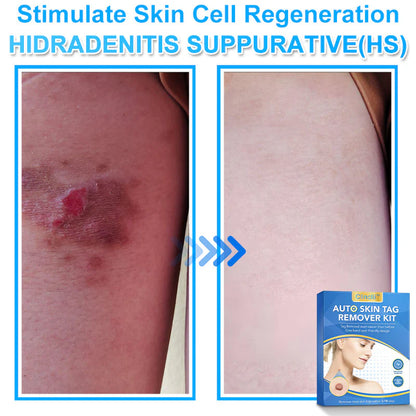 🔥MicroNeedle Botanic Skin Tag Removal kit 🇺🇸 Made in the USA👨‍⚕️