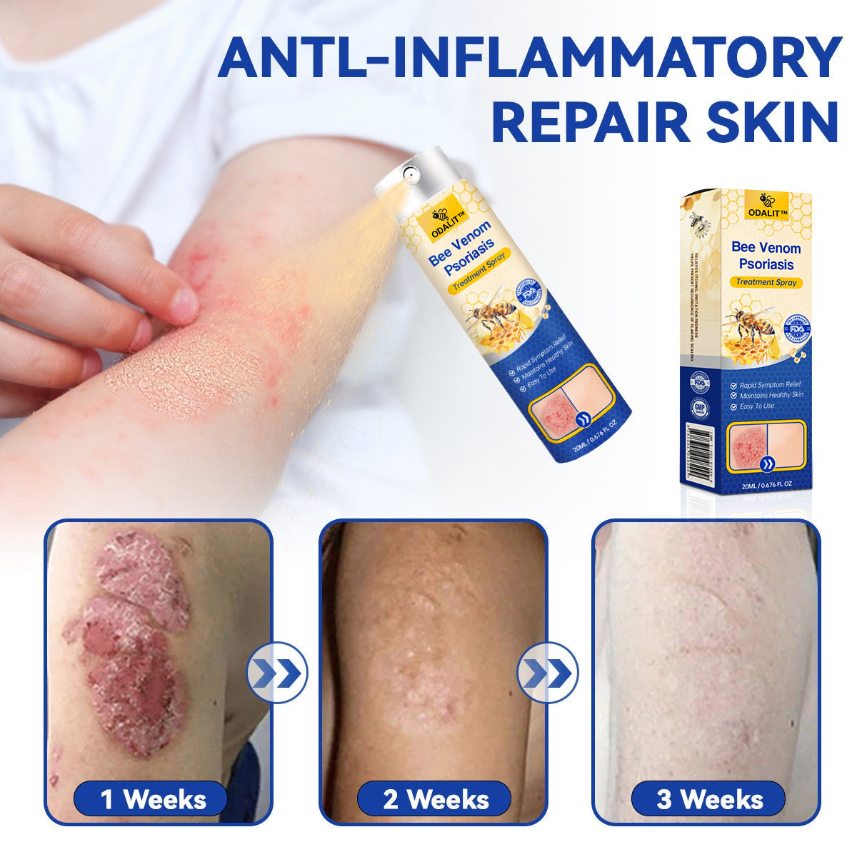 ODALIT™ PsoriaHeal Bee Venom Psoriasis Treatment Spray pro