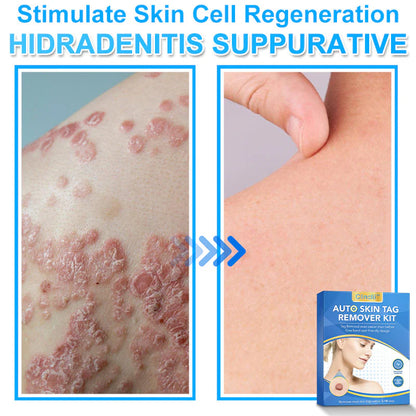 🔥MicroNeedle Botanic Skin Tag Removal kit 🇺🇸 Made in the USA👨‍⚕️