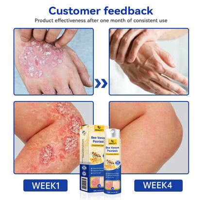ODALIT™ PsoriaHeal Bee Venom Psoriasis Treatment Spray pro