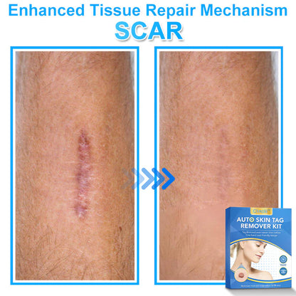 🔥MicroNeedle Botanic Skin Tag Removal kit 🇺🇸 Made in the USA👨‍⚕️