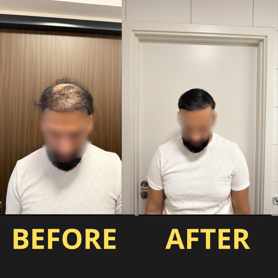 Hairfillup Hair Concealer BLACK 50ML - Waterproof 3–7 days.