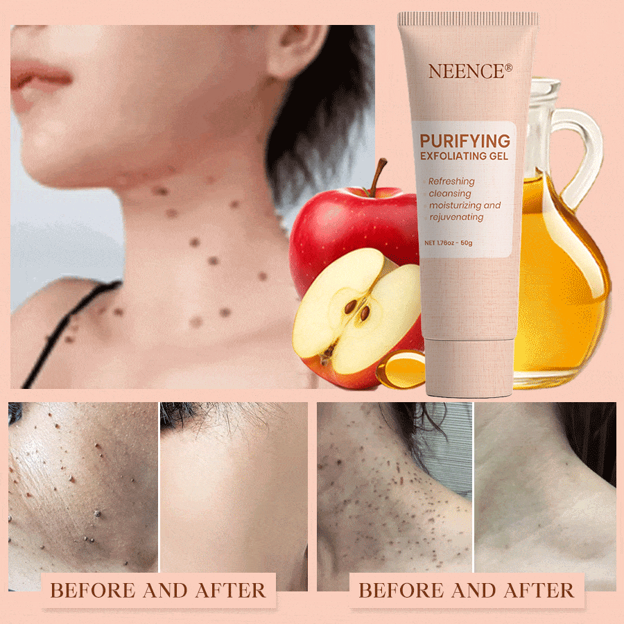 NEENCE® Purifying Exfoliating Gel for Acanthosis Nigricans, Exfoliation, Dark Spots, Skin Tags, and Eczema_Ultra01