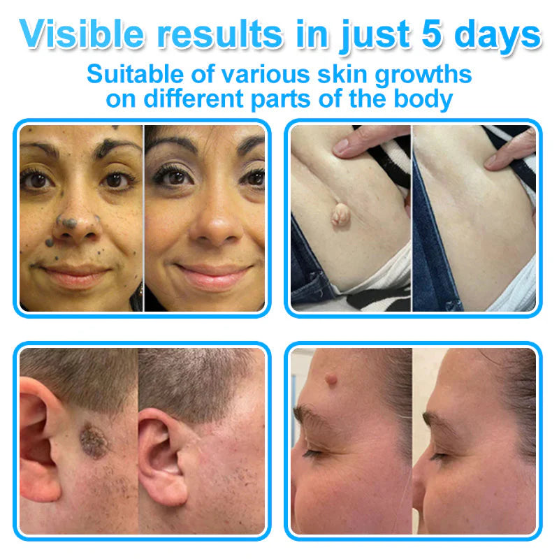 🔥MicroNeedle Botanic Skin Tag Removal kit 🇺🇸 Made in the USA👨‍⚕️