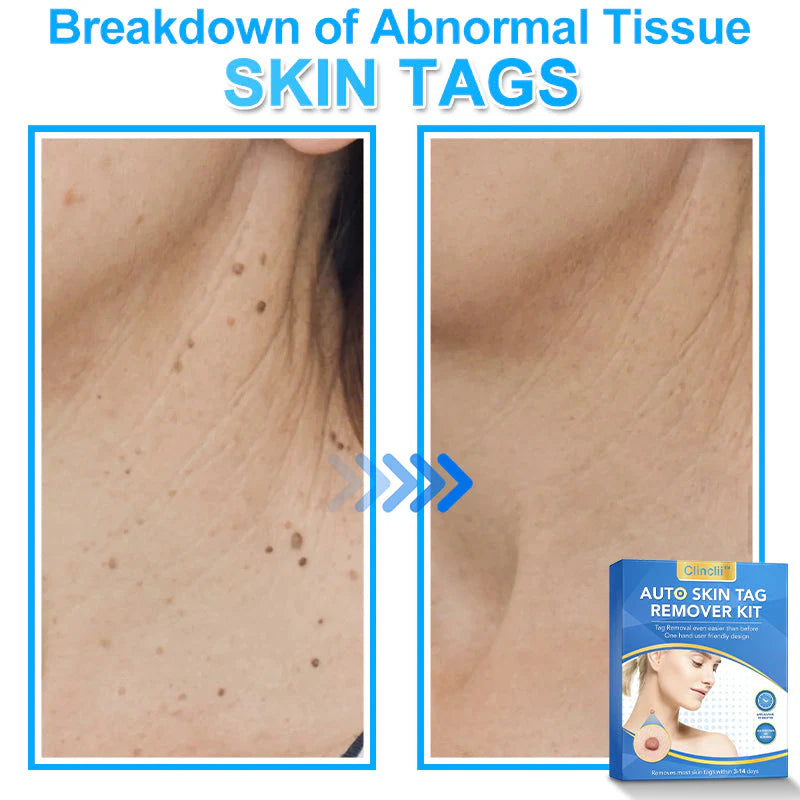 🔥MicroNeedle Botanic Skin Tag Removal kit 🇺🇸 Made in the USA👨‍⚕️