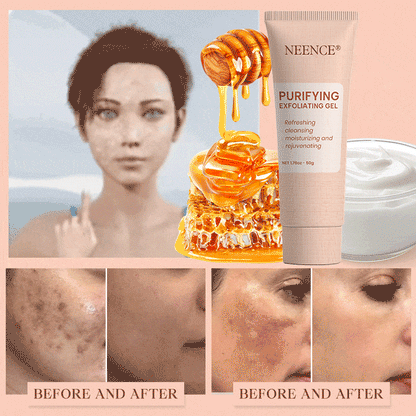 NEENCE® Purifying Exfoliating Gel for Acanthosis Nigricans, Exfoliation, Dark Spots, Skin Tags, and Eczema_Ultra01