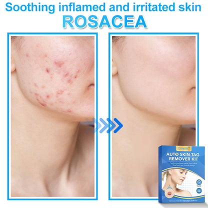 🔥MicroNeedle Botanic Skin Tag Removal kit 🇺🇸 Made in the USA👨‍⚕️