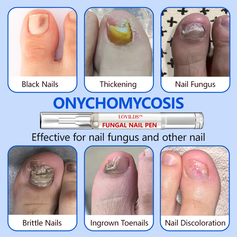 Nail Pen with Allicin & Undecylenic Acid, Nail Health Care Pen, Nail Fungus Care Pen for Solving Fungal Nails and Other Nail Problems,