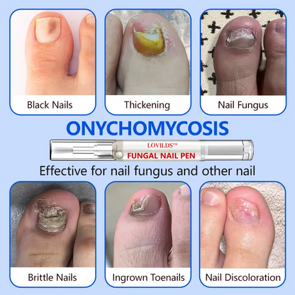 Nail Pen with Allicin & Undecylenic Acid, Nail Health Care Pen, Nail Fungus Care Pen for Solving Fungal Nails and Other Nail Problems,