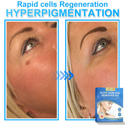 🔥MicroNeedle Botanic Skin Tag Removal kit 🇺🇸 Made in the USA👨‍⚕️