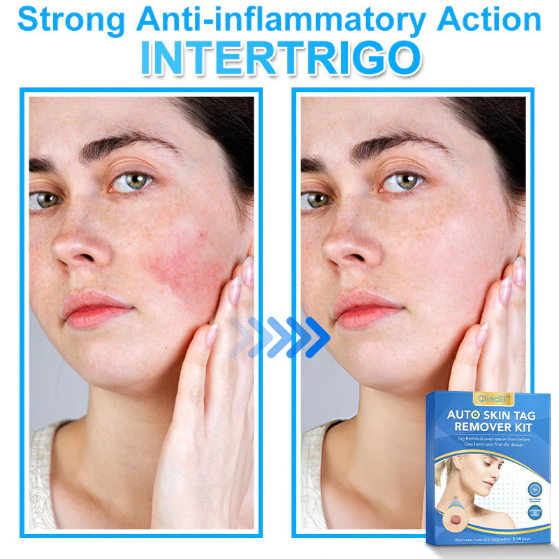 🔥MicroNeedle Botanic Skin Tag Removal kit 🇺🇸 Made in the USA👨‍⚕️