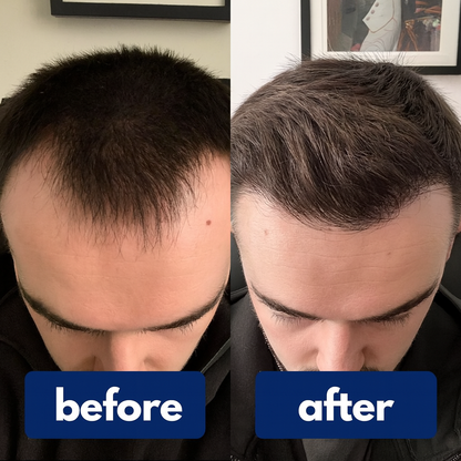 🔥Lightning Grow Hair Serum🔥